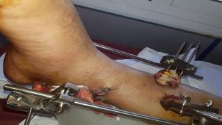 سيدي بيبي: متضررون من حوادث سير يشتكون من فرار سائقي الدراجات النارية، وغياب الدرك