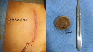 فريق طبي بورزازات ينجح في إستخراج حصى كبيرة على مستوى مثانة طفل يبلغ من العمر 13 عاما